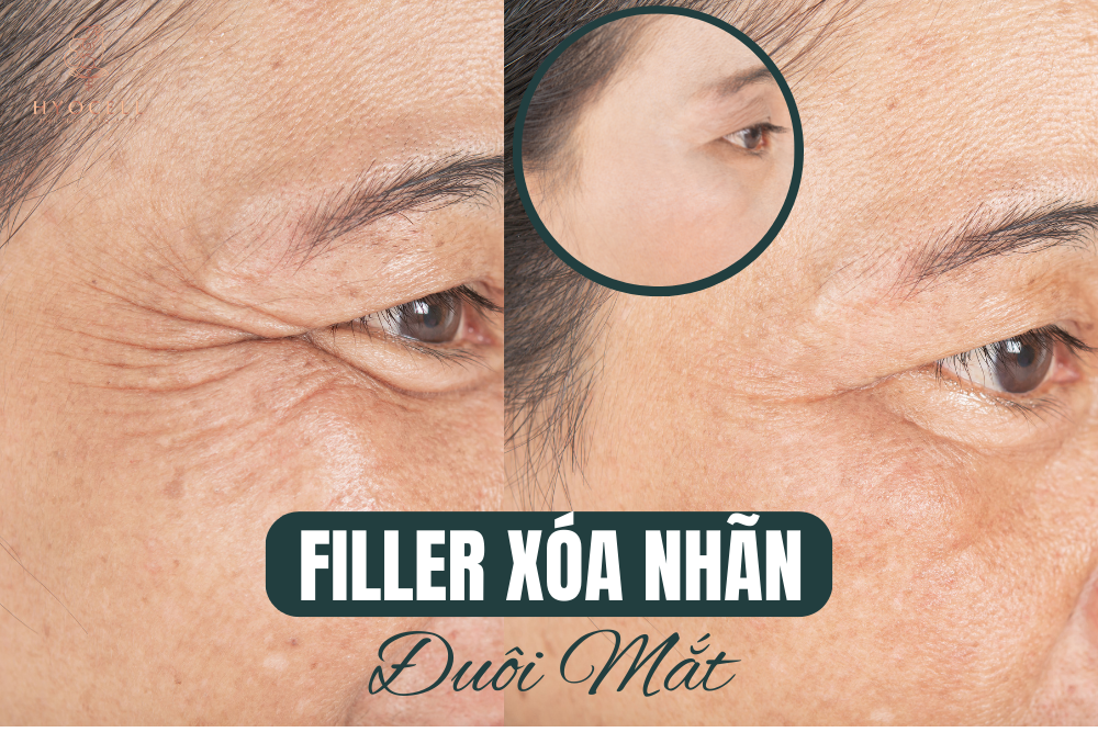 filler Xóa nhãn đuôi mắt