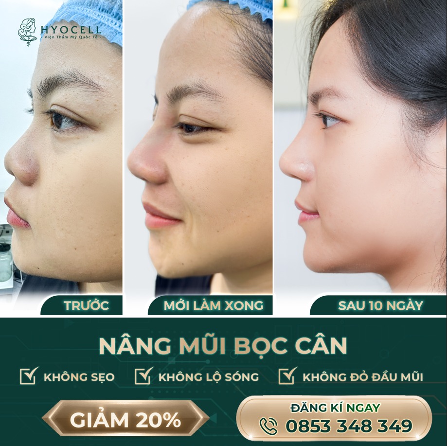 Nâng mũi bọc sụn