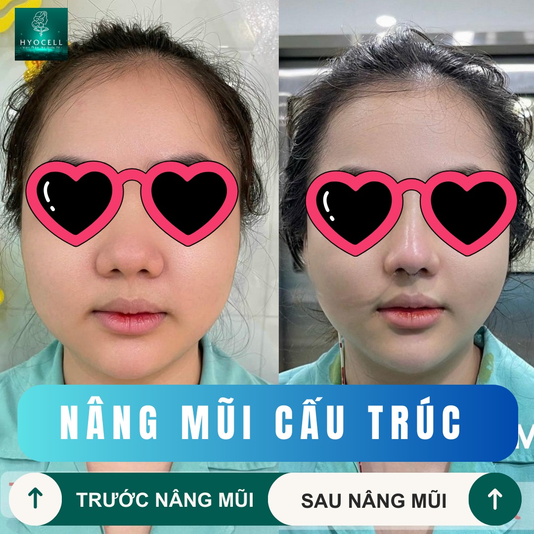 Nâng mũi cấu trúc
