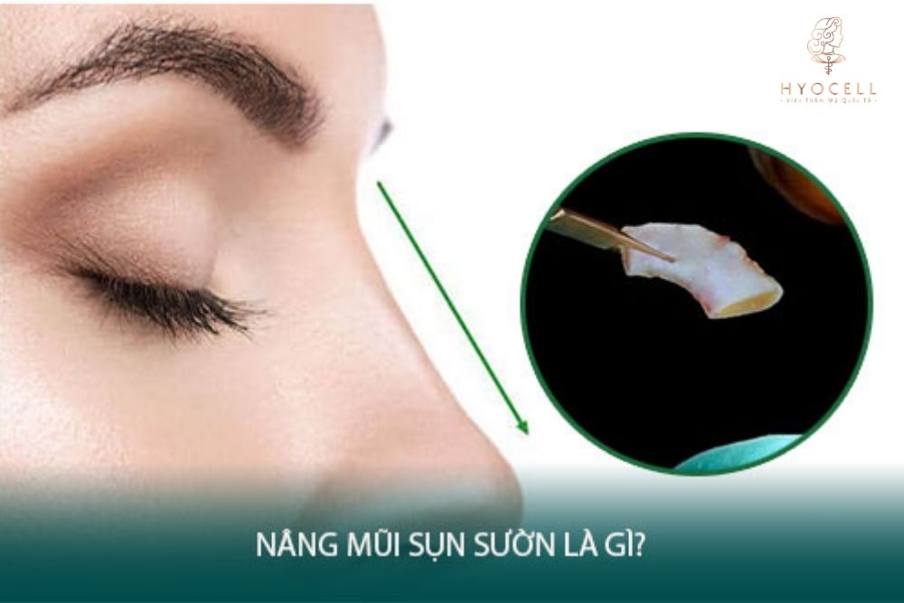 Nâng mũi sụn sườn 100%