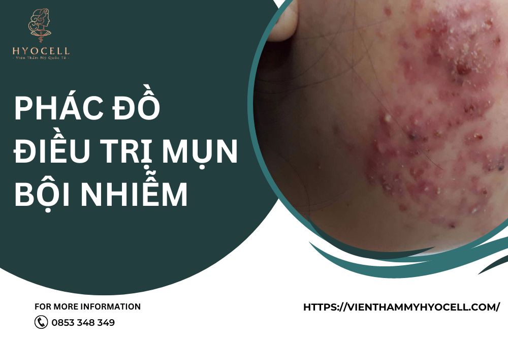 Phác đồ điều trị mụn bội nhiễm