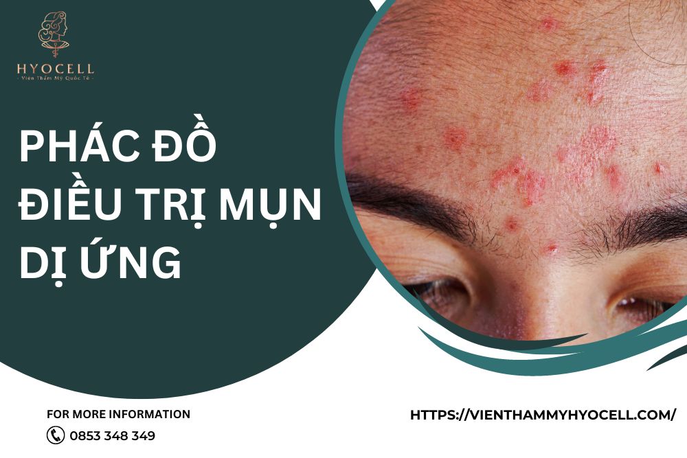 Phác đồ điều trị mụn dị ứng