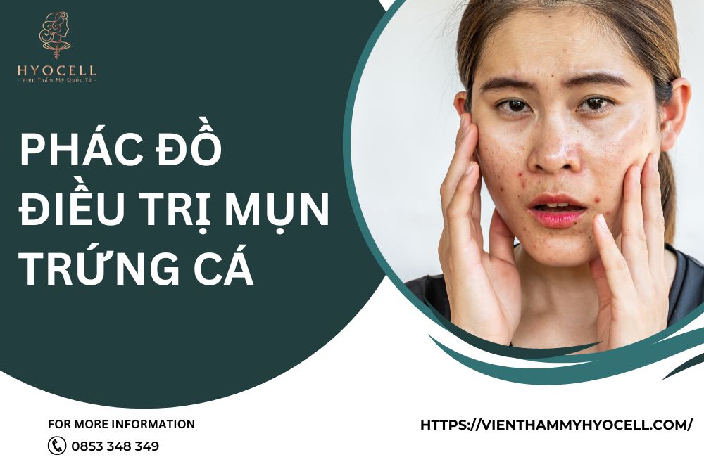 Phác đồ điều trị mụn trứng cá