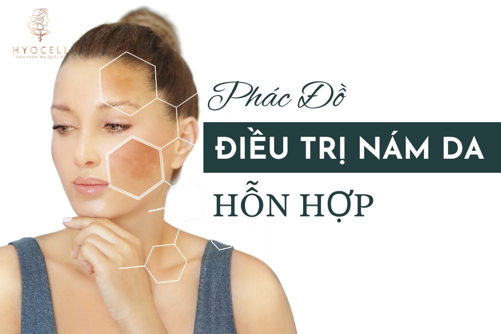 Phác đồ điều trị nám hỗn hợp