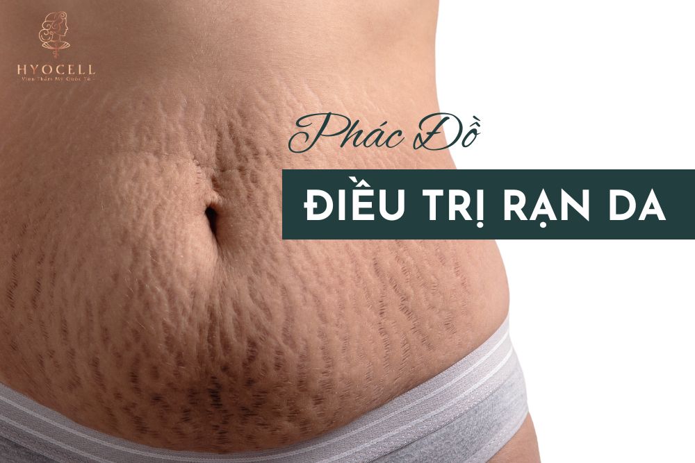 Phác đồ điều trị rạn da