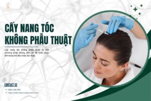 Cấy nang tóc không phẫu thuật