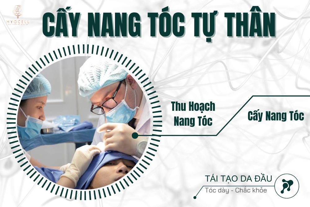 cấy nang tóc tự thân