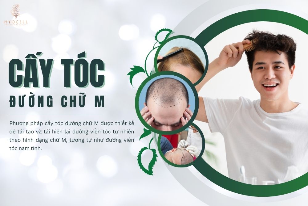 cấy tóc đường chữ M