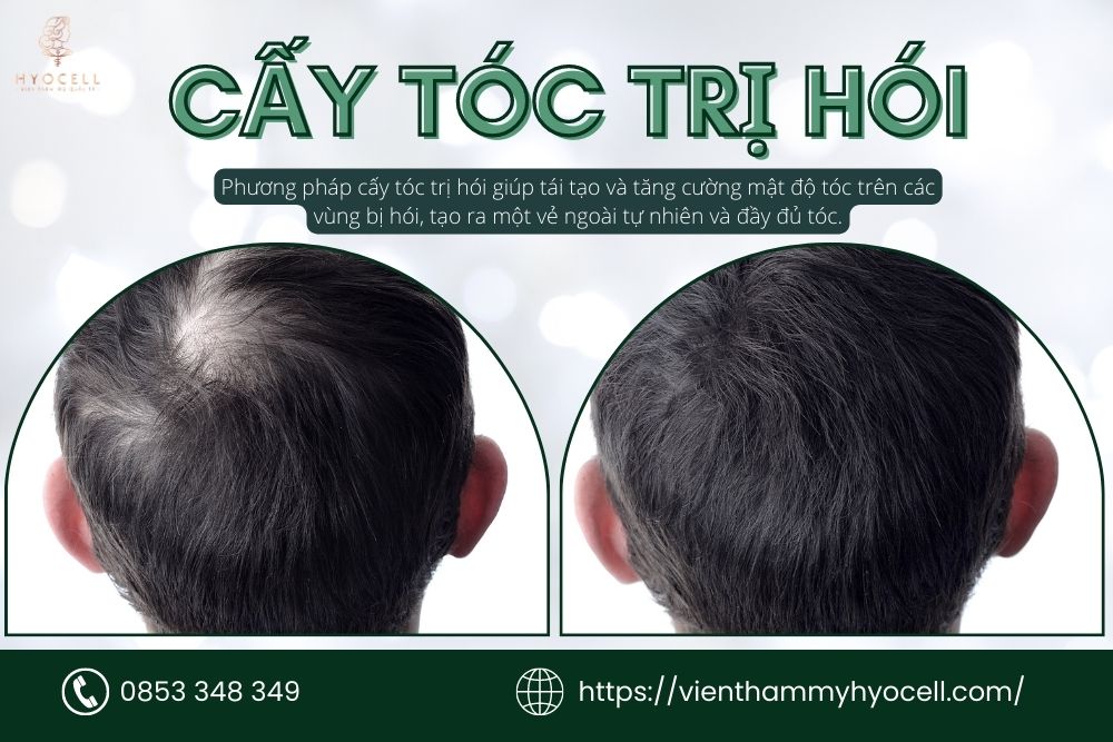 cấy tóc trị hói