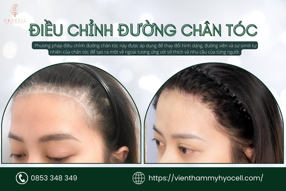 điều chỉnh đường chân tóc